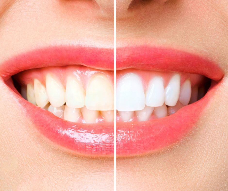 Blanqueamientos dentales
