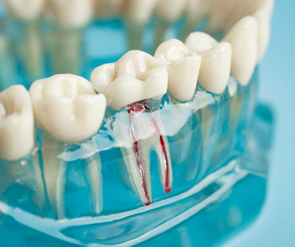 Endodoncias