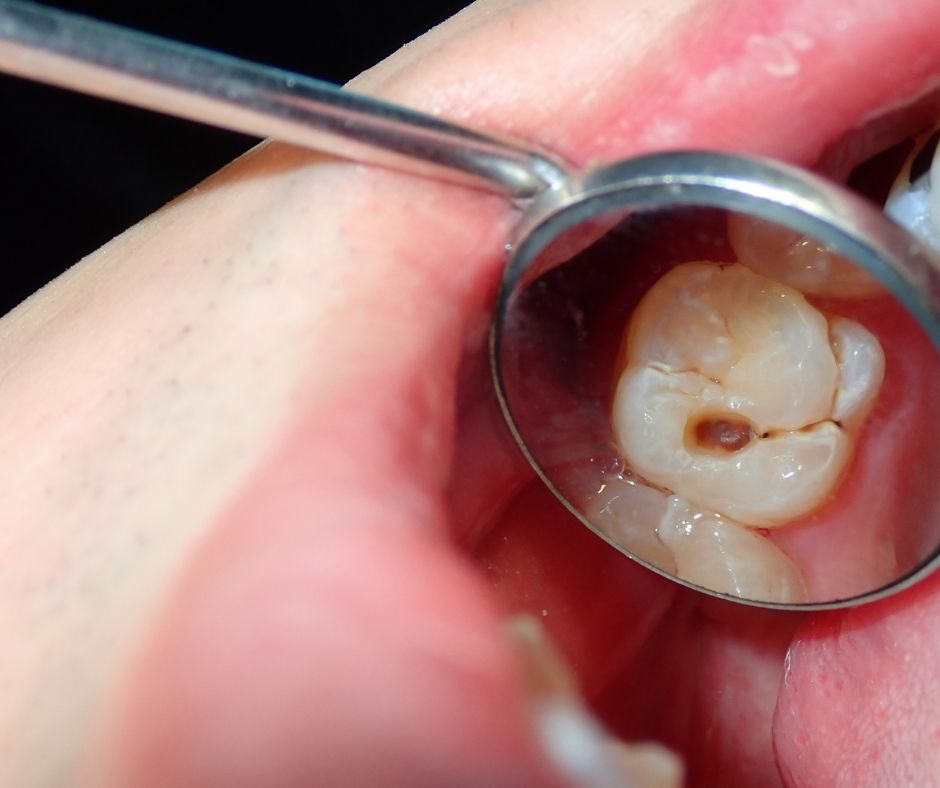 Resinas dentales
